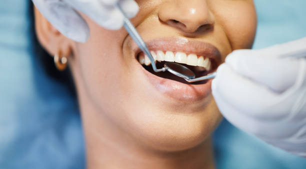Best Emergency Wisdom Tooth Extraction in Lakehills, TX